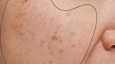 Pigmentové skvrny na tváři ženy zvýrazněné černou čarou.
