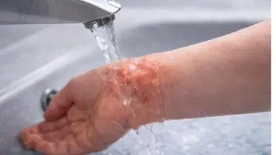 Popálený předloktí pod studenou vodou kohoutku.