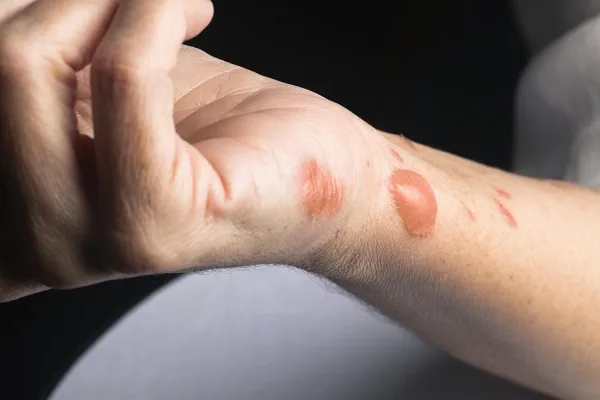 Popálenina s puchýři na předloktí po kontaktu se horkou vodou.