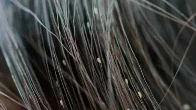 Head lice eggs on hair