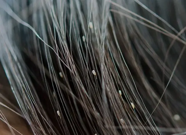 Head lice eggs on hair