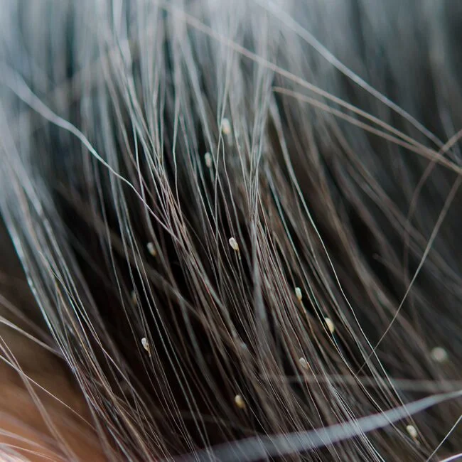 Head lice eggs on hair